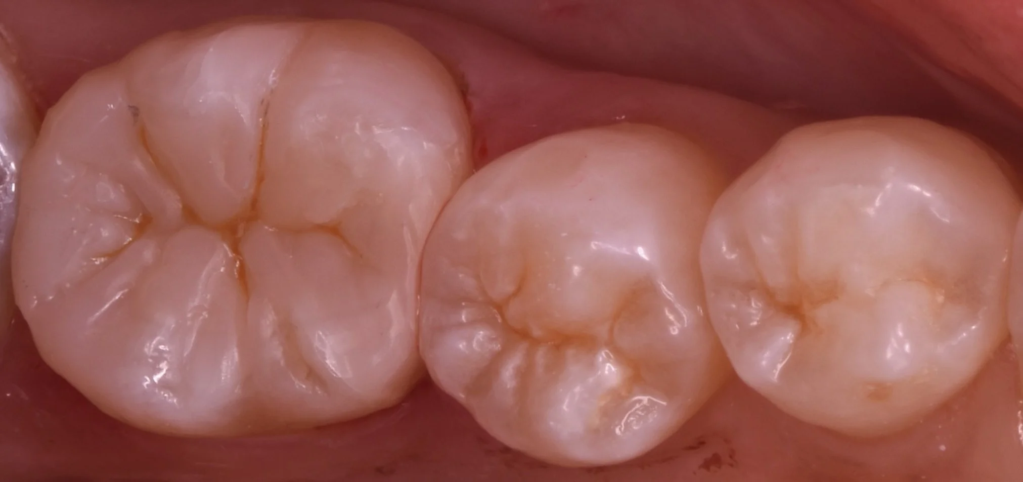 詰め物が脱離した所を即日で白い詰め物に。|坂寄歯科医院(取手市藤代) - 画像4