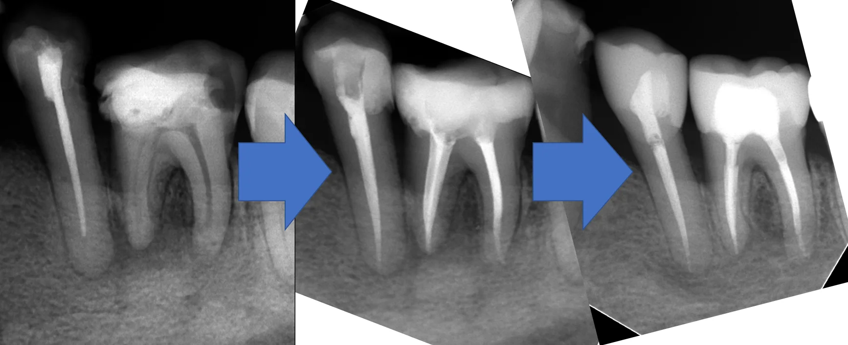 レジンでは無理ですって!再び・・・。|坂寄歯科医院(取手市藤代) - 画像4