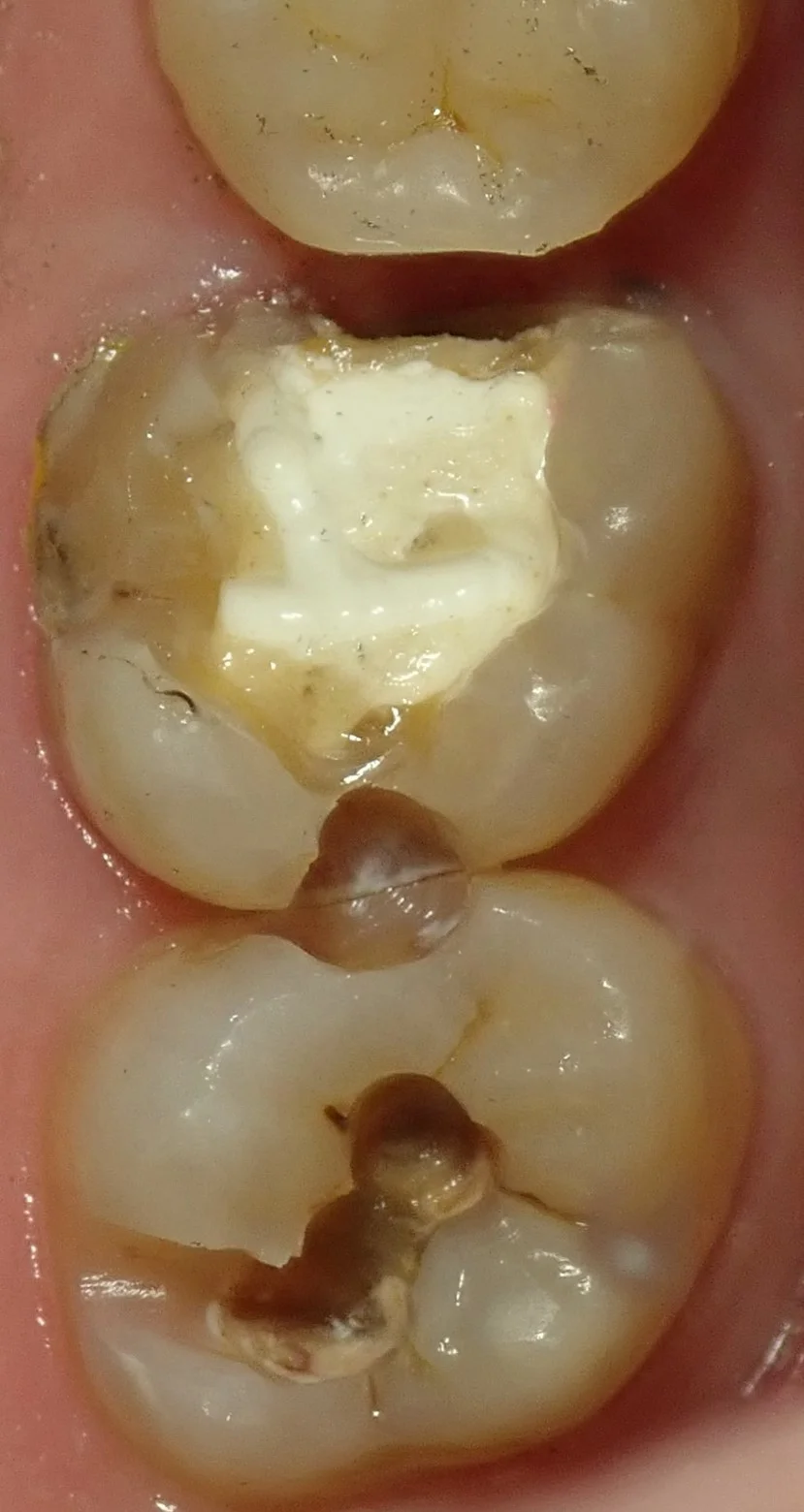 左上奥歯の白い詰め物｜坂寄歯科医院（取手市藤代） - 画像2