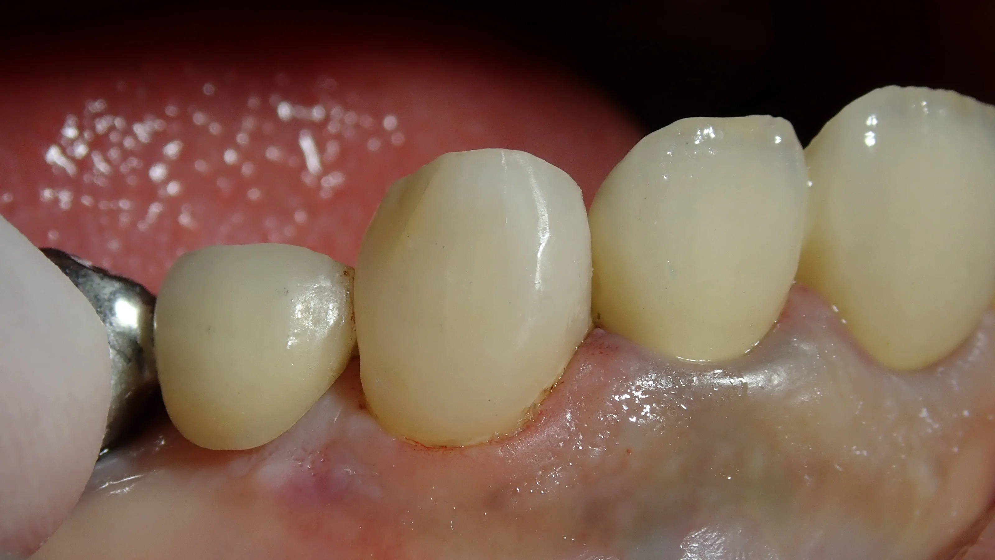 犬歯ダイレクトボンディング|坂寄歯科医院(取手市藤代) - 画像4