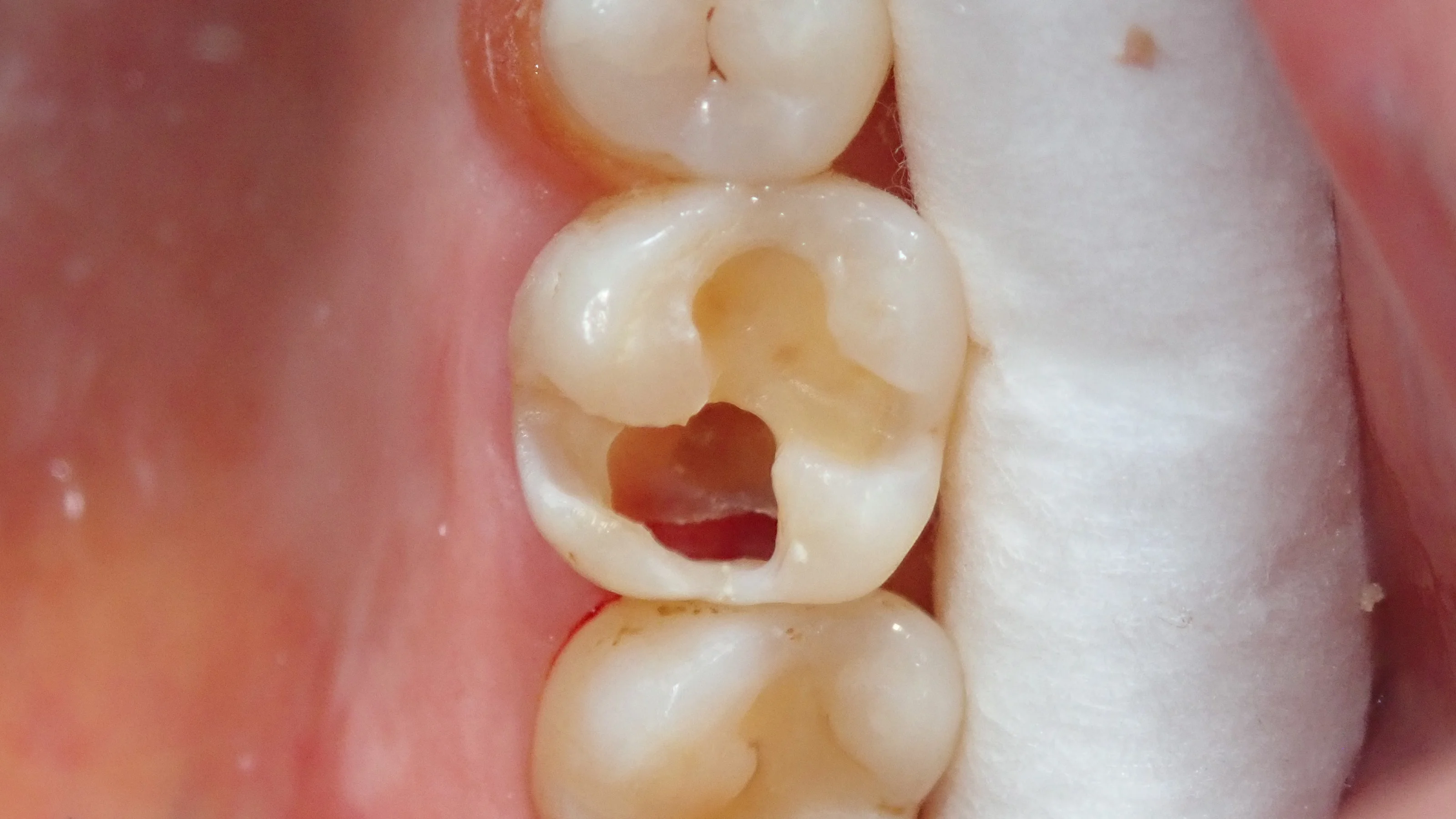 ダイレクトボンディング③（臼歯）｜坂寄歯科医院（取手市藤代） - 画像2