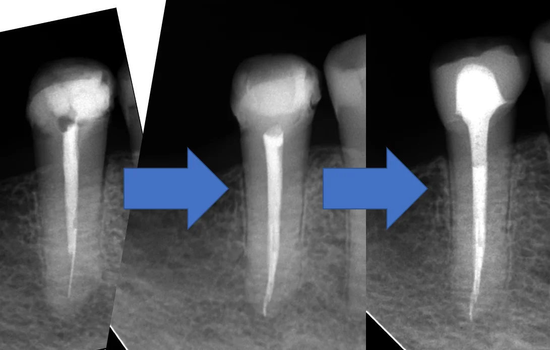 レジンでは無理ですって!|坂寄歯科医院(取手市藤代) - 画像4