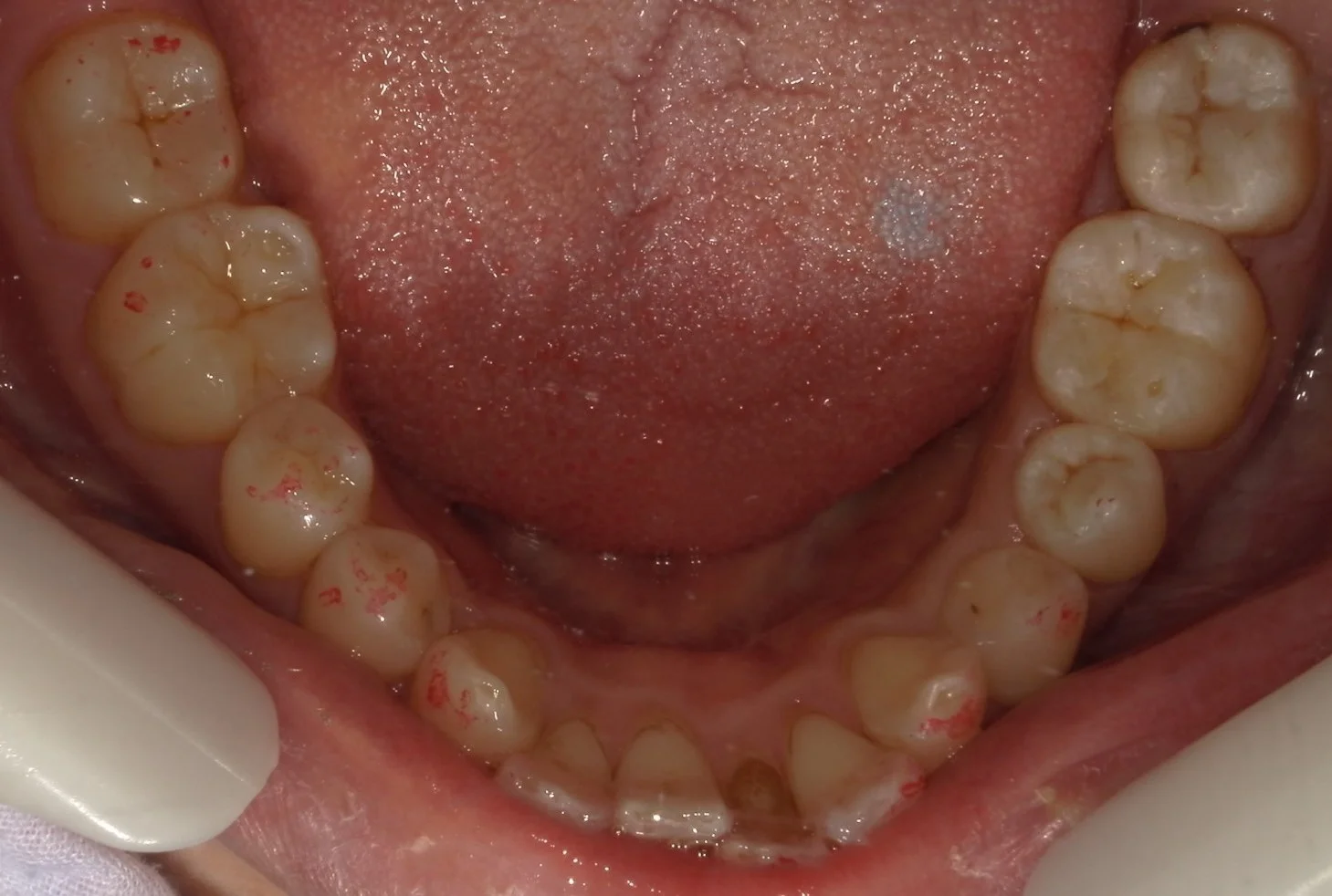 １回で纏めて一気に白い歯へ。｜坂寄歯科医院（取手市藤代） - 画像6