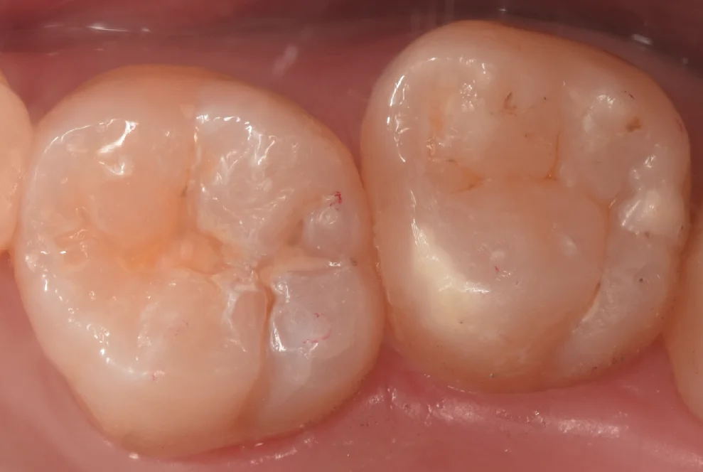 新しくできた虫歯と古い詰め物を同時に治療。|坂寄歯科医院(取手市藤代) - 画像4