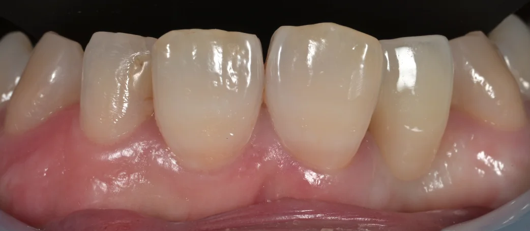 審美治療+歯質保存:延長セラミックブリッジ|坂寄歯科医院(取手市藤代) - 画像2