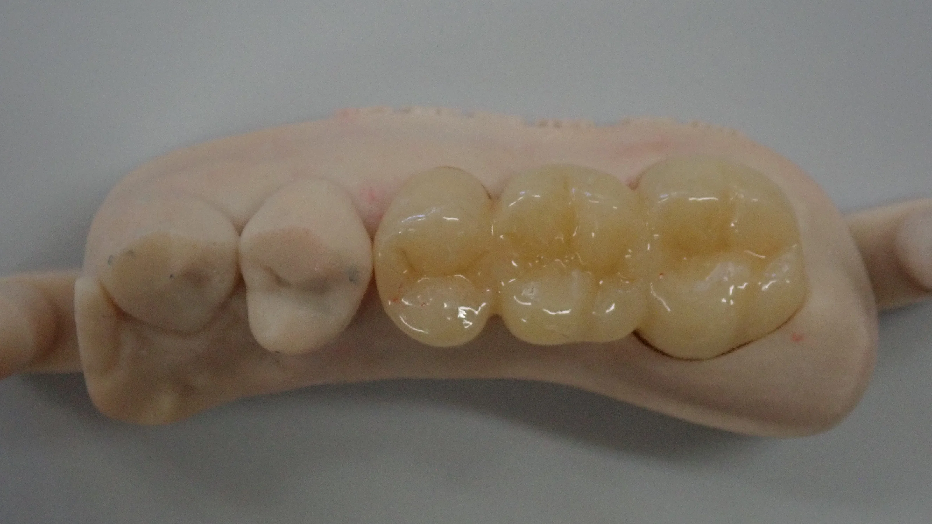 奥歯のセラミックブリッジ|坂寄歯科医院(取手市藤代) - 画像3