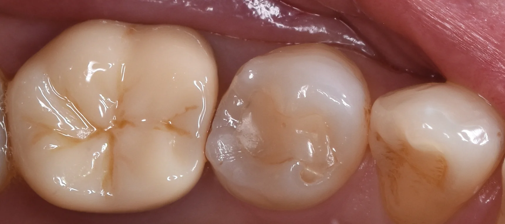 セラミックの被せ物|坂寄歯科医院(取手市藤代) - 画像5