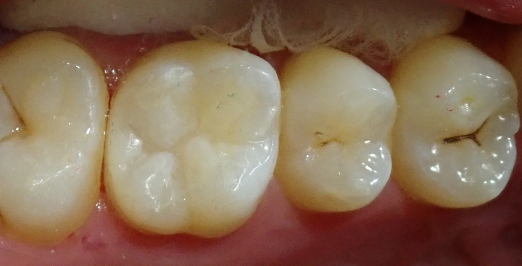 テフロンテープを用いたレジン治療｜坂寄歯科医院（取手市藤代） - 画像5