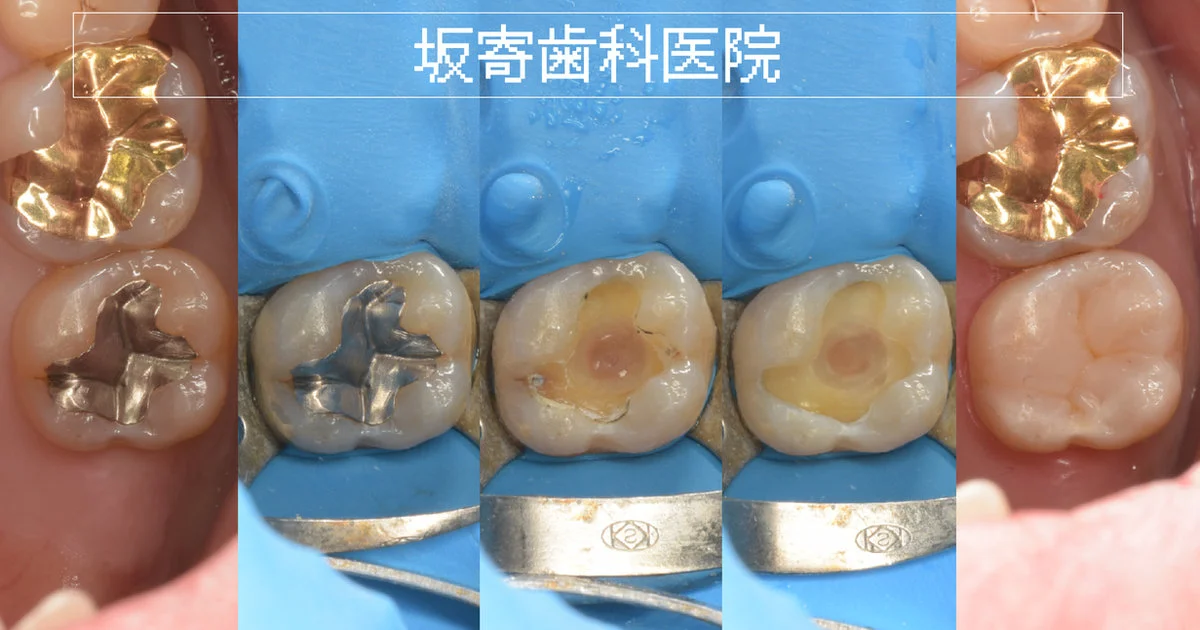 ブログ・お役立ち情報｜坂寄歯科医院（取手市藤代）