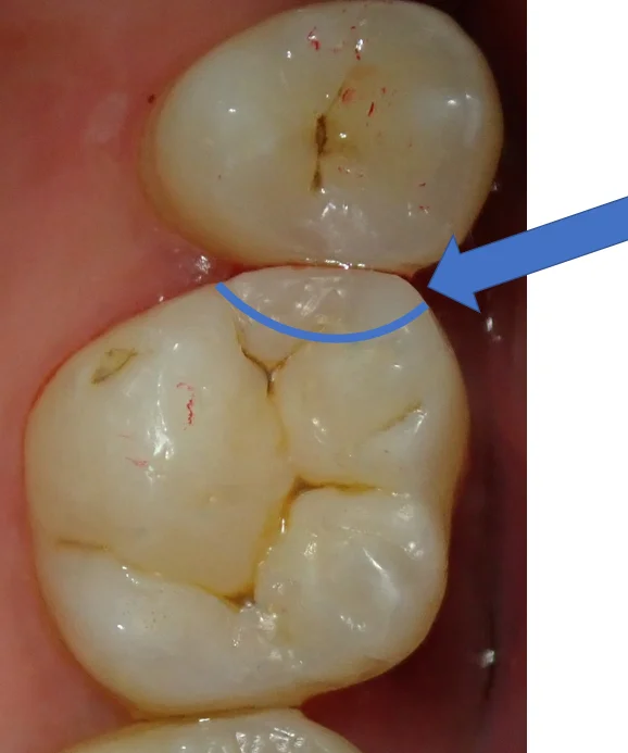 ダイレクトボンディング⑨｜坂寄歯科医院（取手市藤代） - 画像3