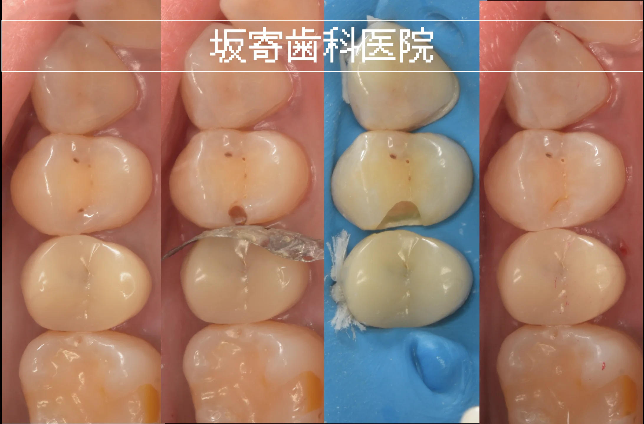 上顎奥歯のむし歯をダイレクトボンディングで治療した症例写真。術前、むし歯除去後、充填前、術後の比較。自然な見た目を保ちながら歯をできるだけ残して修復している様子。