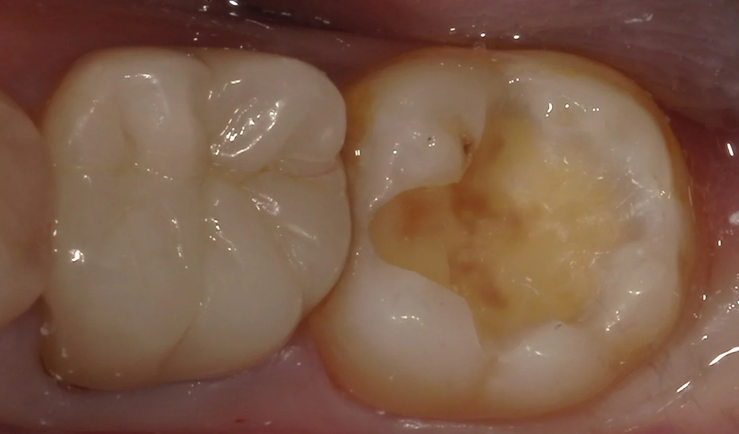 遠方より虫歯の治療で通院された方を一日で治療しました。|坂寄歯科医院(取手市藤代) - 画像3
