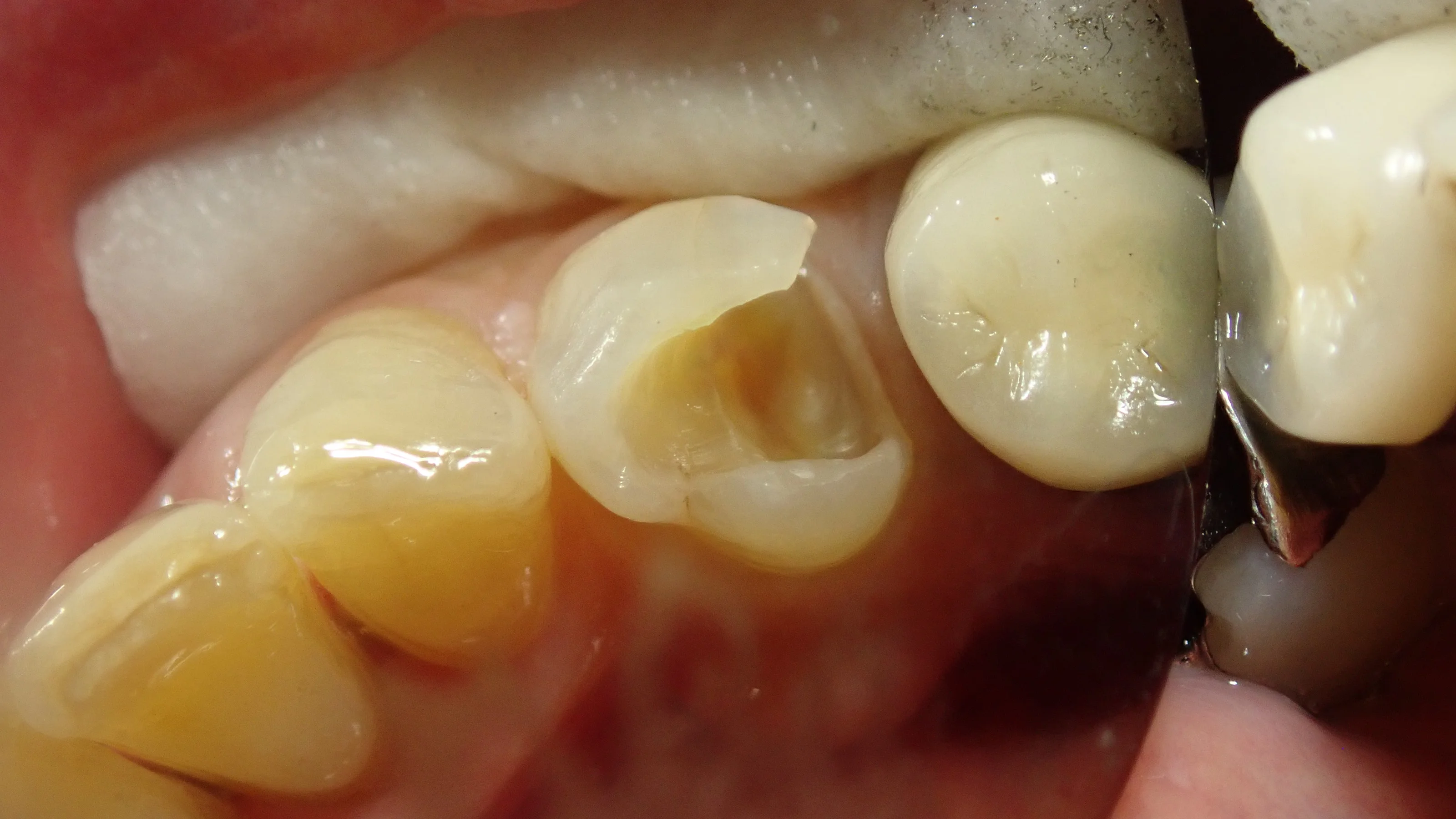 ダイレクトボンディング|坂寄歯科医院(取手市藤代) - 画像3