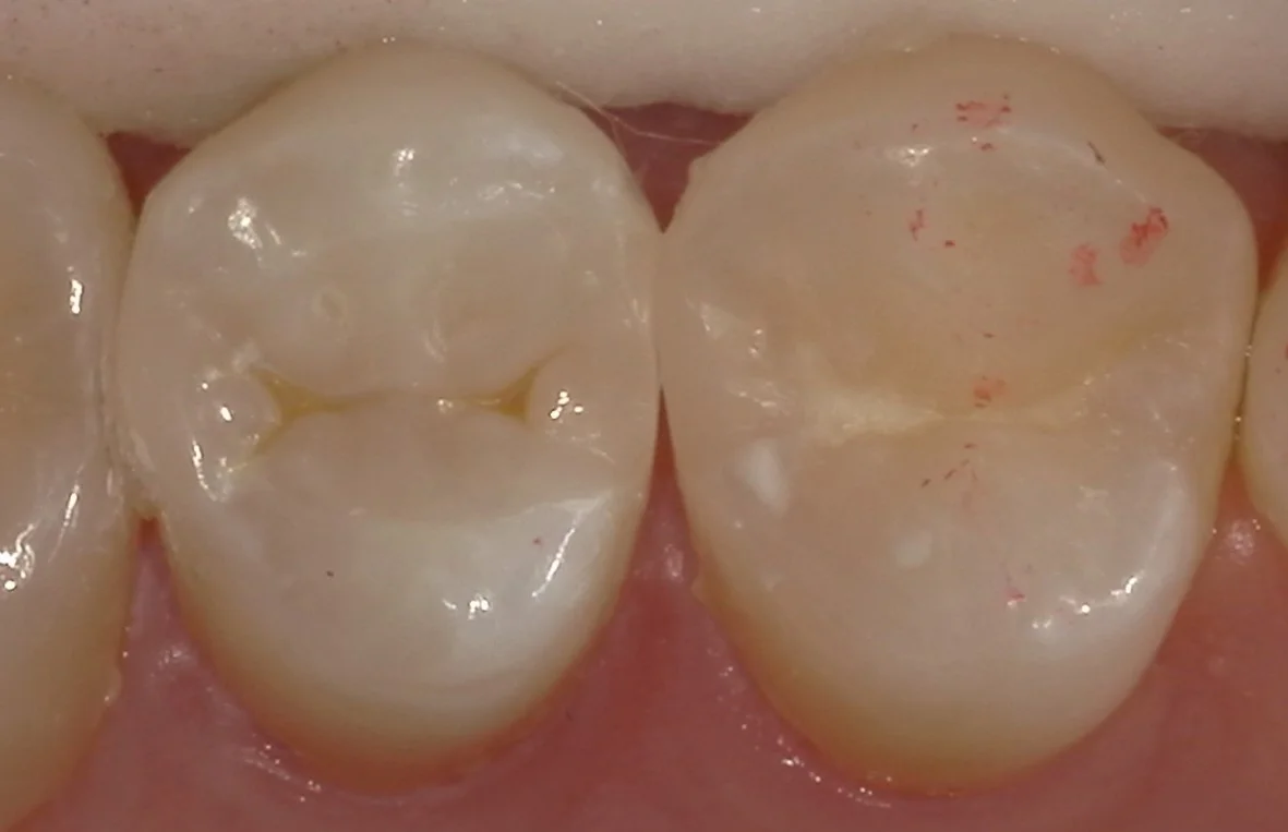 歯科医師の方の虫歯治療。｜坂寄歯科医院（取手市藤代） - 画像4