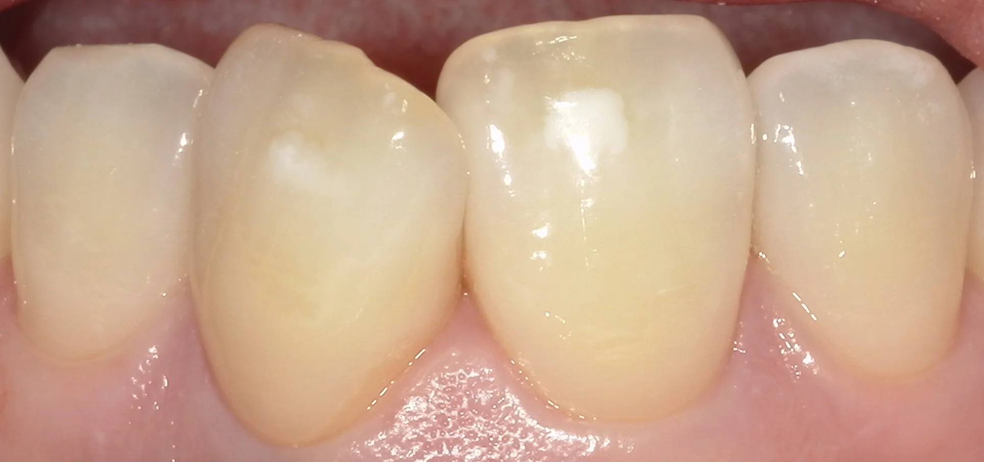 ICON治療(低侵襲ホワイトスポット改善治療)を始めました。｜坂寄歯科医院（取手市藤代） - 画像2