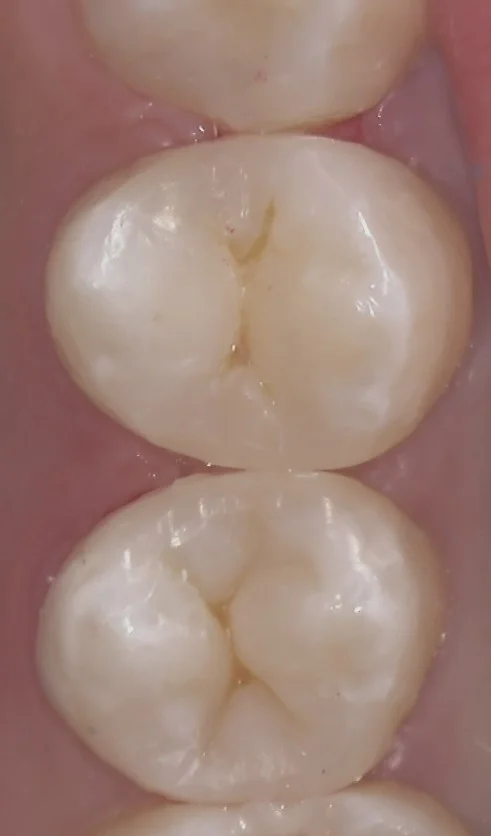 右上小さい奥歯の白い詰め物｜坂寄歯科医院（取手市藤代） - 画像3