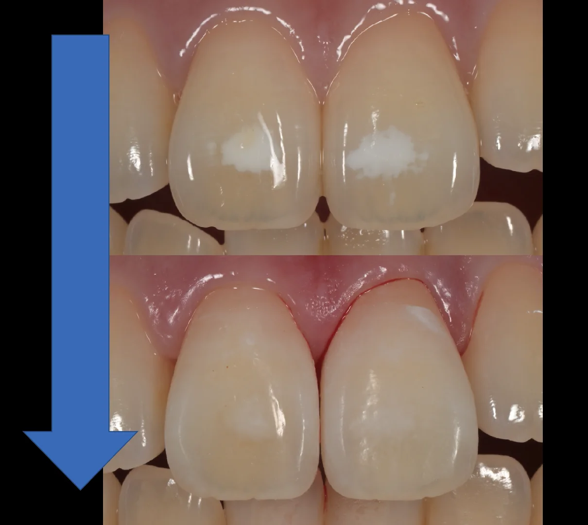 ICON治療。｜坂寄歯科医院（取手市藤代） - 画像7