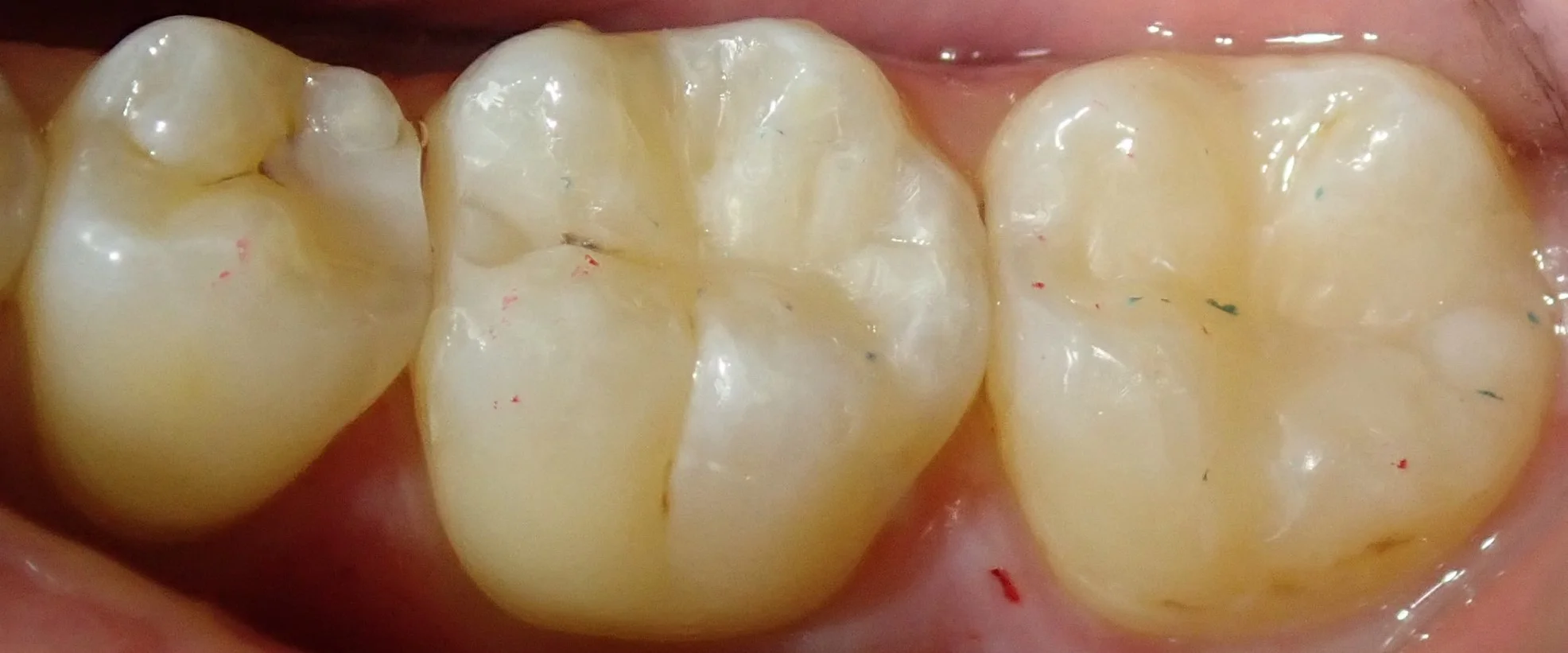 左下奥2本の白い詰め物｜坂寄歯科医院（取手市藤代） - 画像3