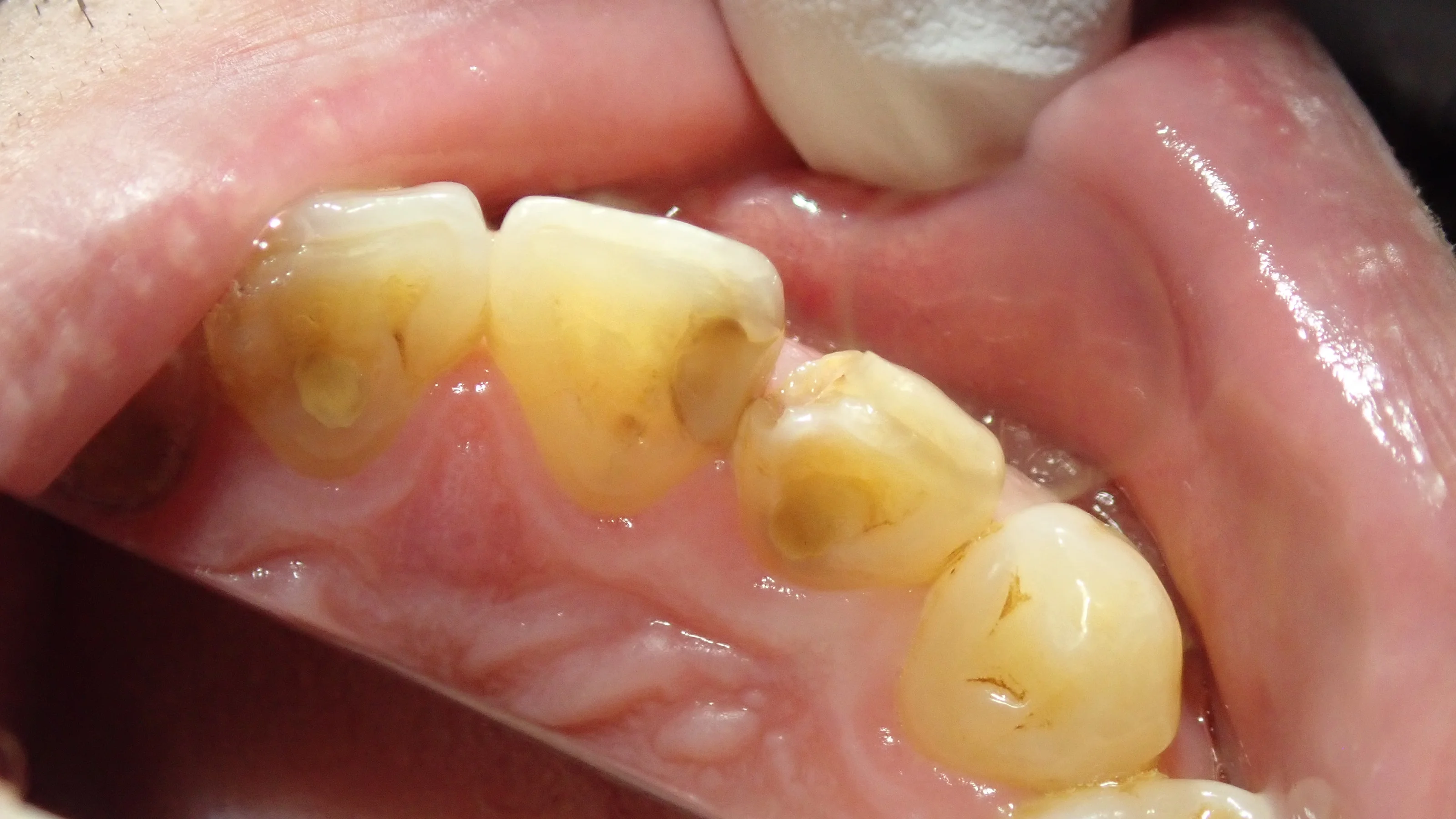 前歯の白い詰め物｜坂寄歯科医院（取手市藤代） - 画像2