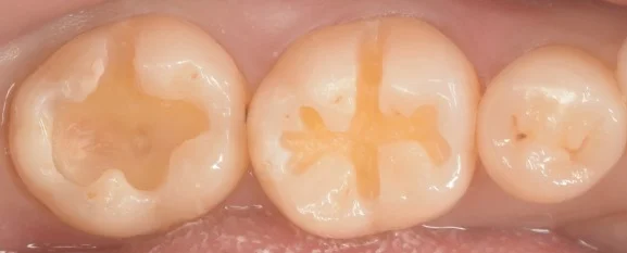 見た目が気になるレジンを天然の歯の様に。｜坂寄歯科医院（取手市藤代） - 画像2