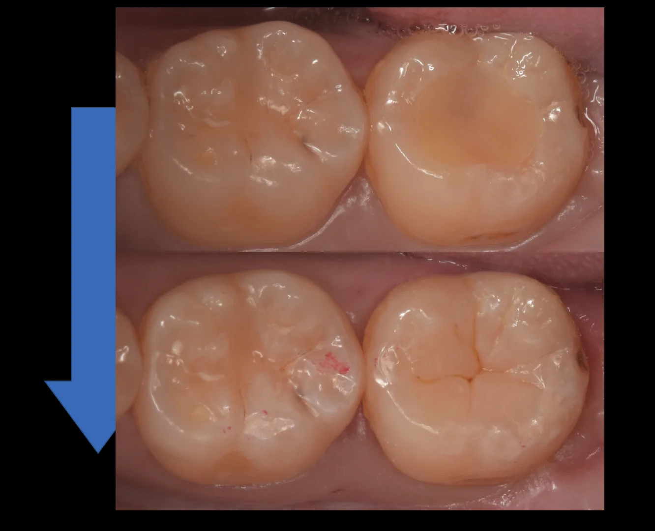 鎌倉からダイレクトボンディングを希望して｜坂寄歯科医院（取手市藤代） - 画像4