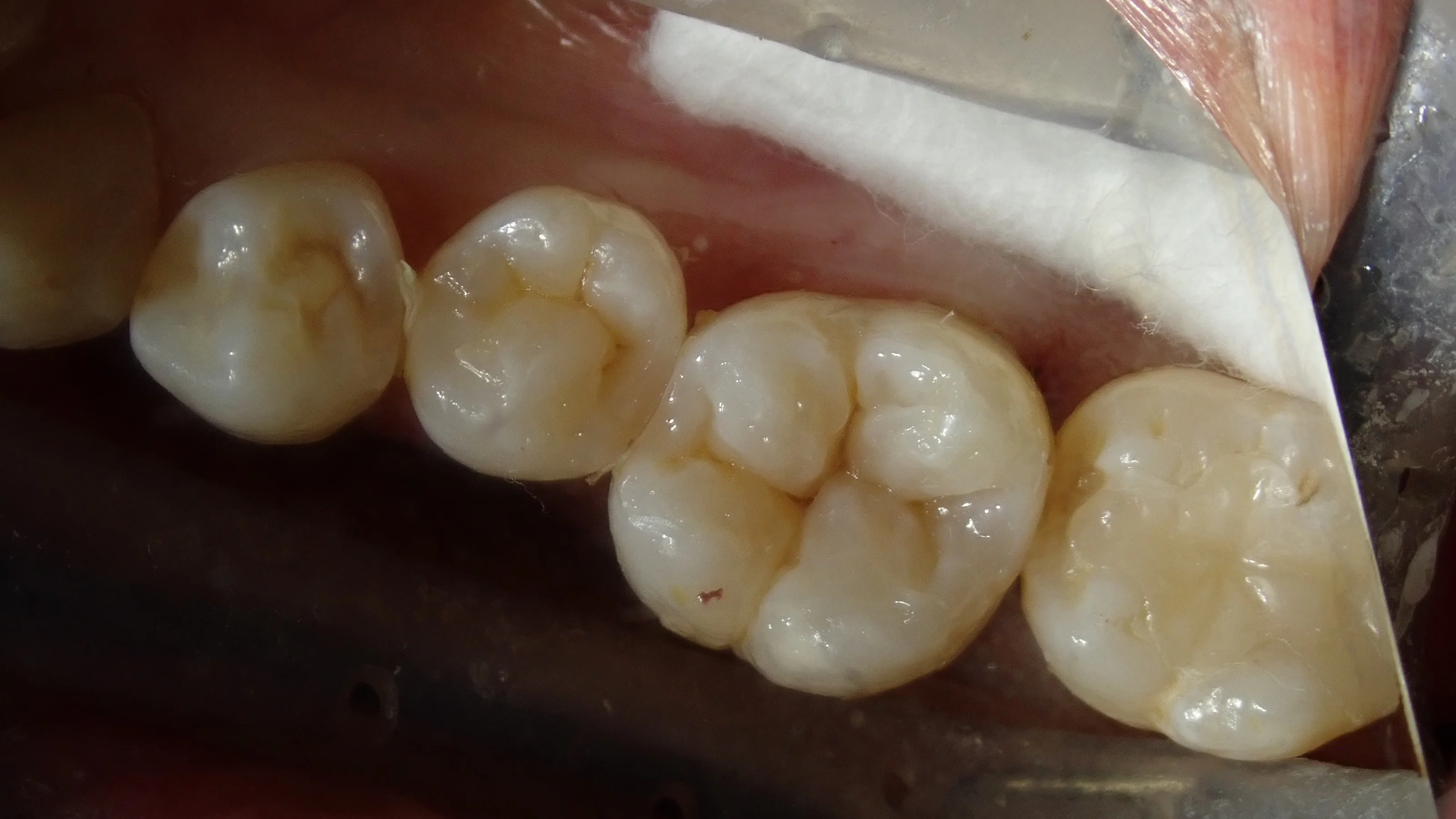 ダイレクトボンディング⑦｜坂寄歯科医院（取手市藤代） - 画像5