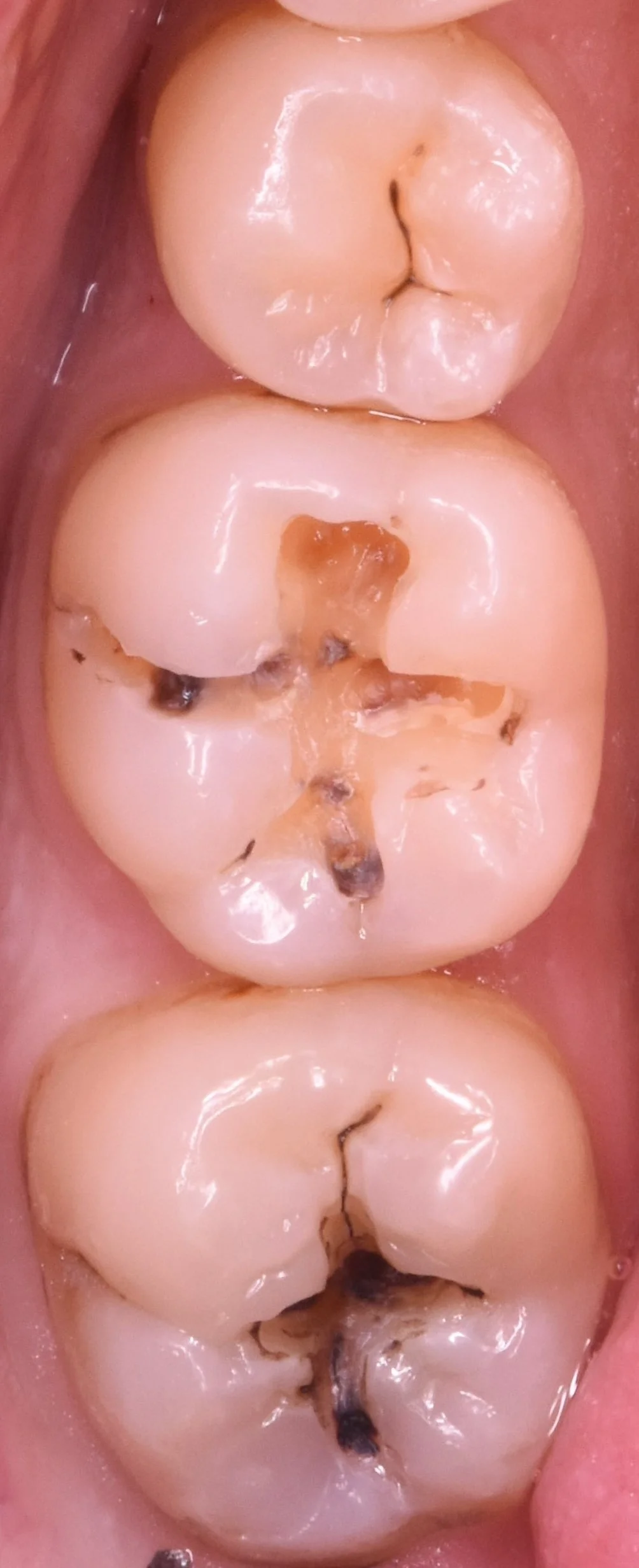 奥歯2本の治療を1日で。｜坂寄歯科医院（取手市藤代） - 画像2