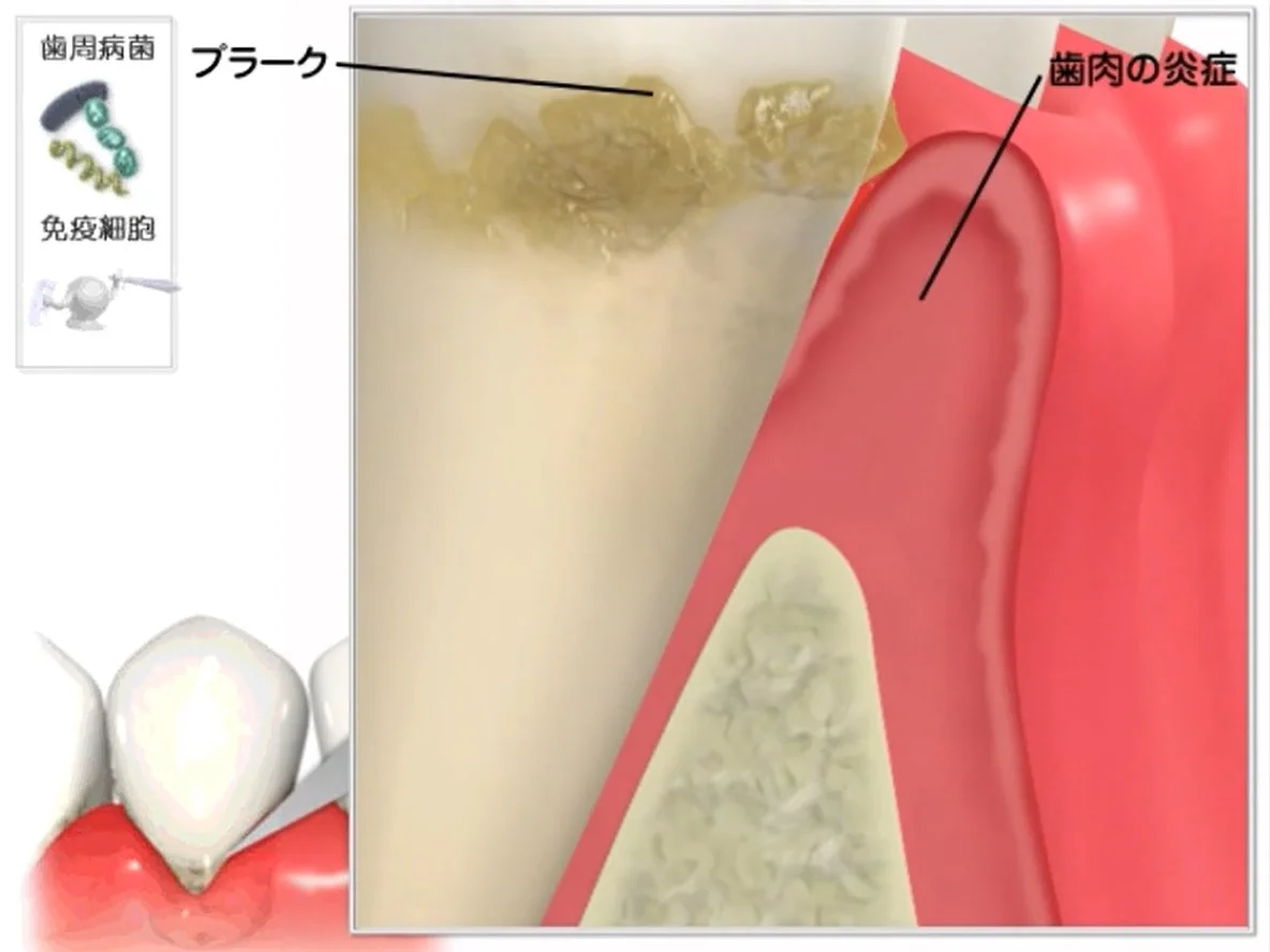 Q&A～歯周病ってなに？①～｜坂寄歯科医院（取手市藤代） - 画像4