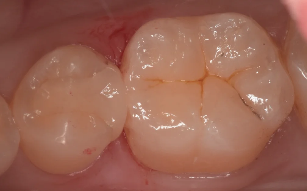 歯科医師の歯を1日で本物の歯のように。｜坂寄歯科医院（取手市藤代） - 画像3