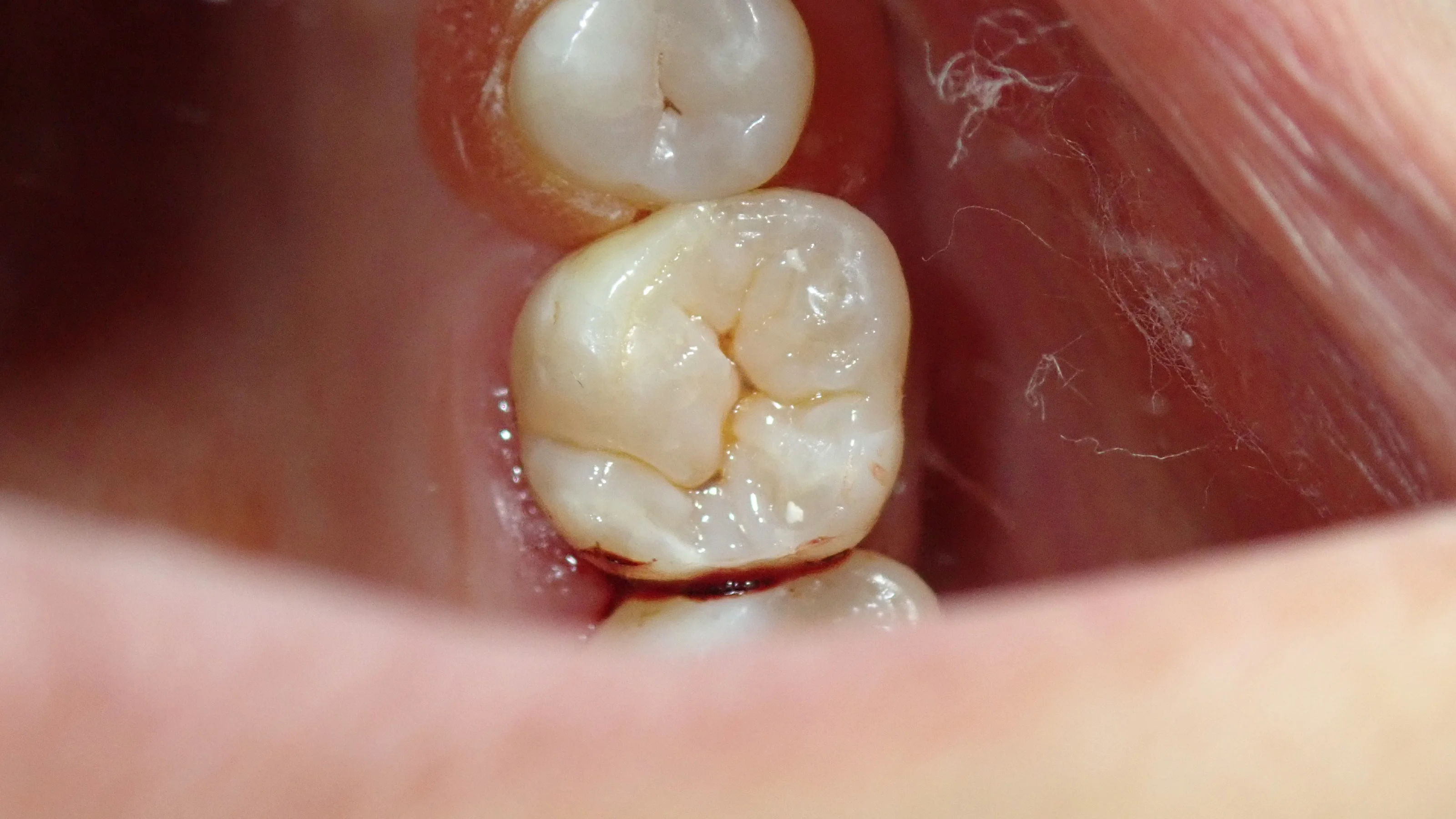 ダイレクトボンディング③（臼歯）｜坂寄歯科医院（取手市藤代） - 画像4