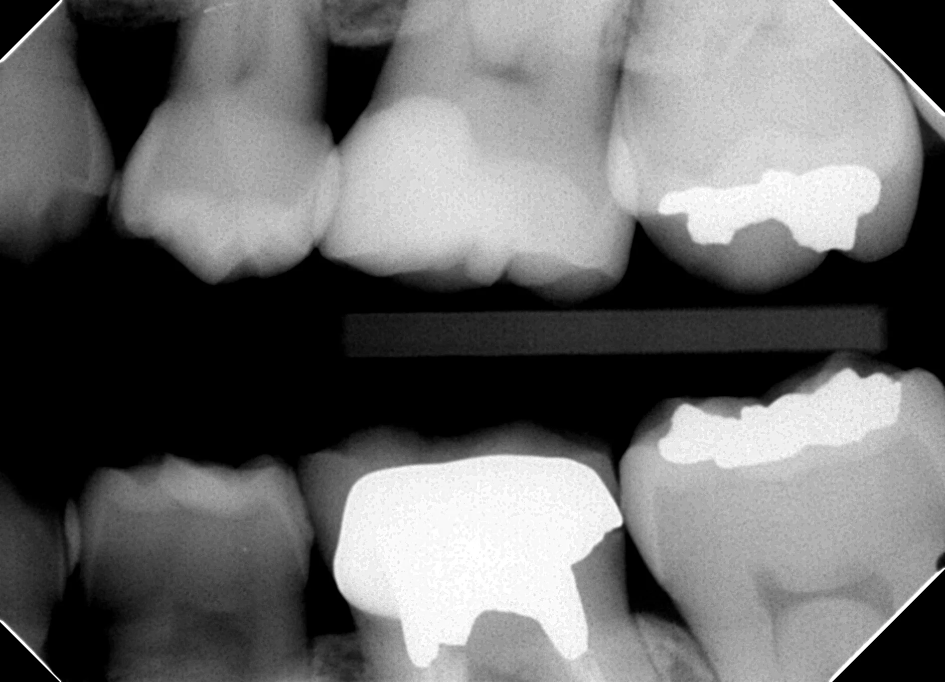 バイトウイング像(左上臼歯部)。Giomer併用コンポジット修復の近遠心マージンと接触点を確認。辺縁適合は良好で、術後2年時点で明らかな二次う蝕所見なし。