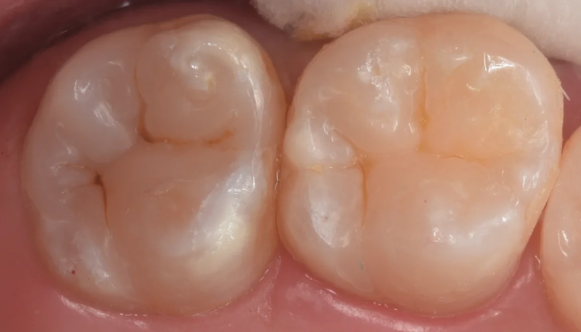 他院で入れたセラミックをダイレクトボンディングに。｜坂寄歯科医院（取手市藤代） - 画像4