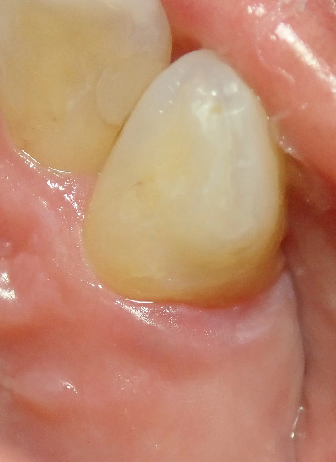 右上犬歯の白い詰め物|坂寄歯科医院(取手市藤代) - 画像6