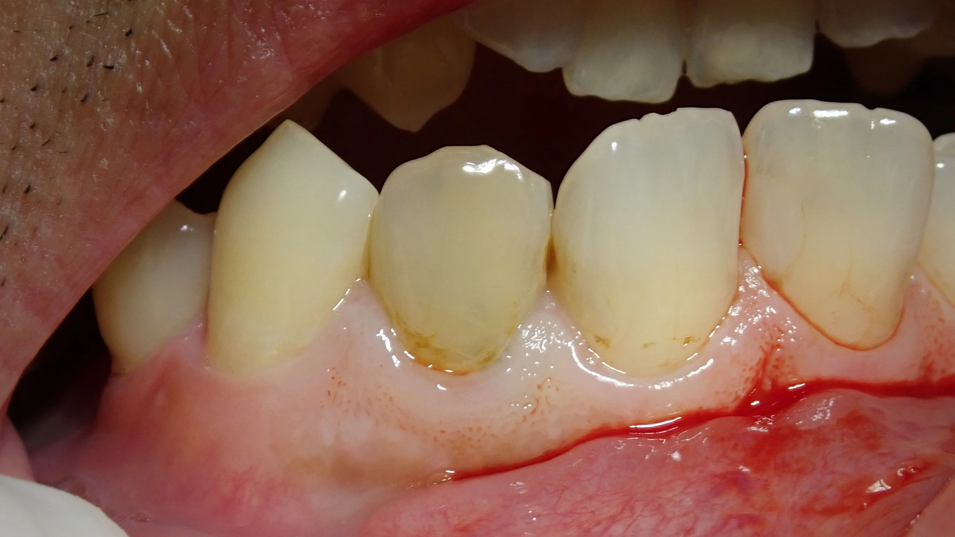 前歯のダイレクトベニア｜坂寄歯科医院（取手市藤代） - 画像2