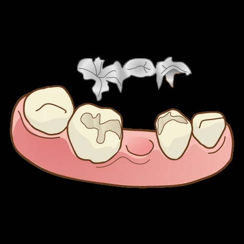 歯を可及的に温存したブリッジ｜坂寄歯科医院（取手市藤代） - 画像3