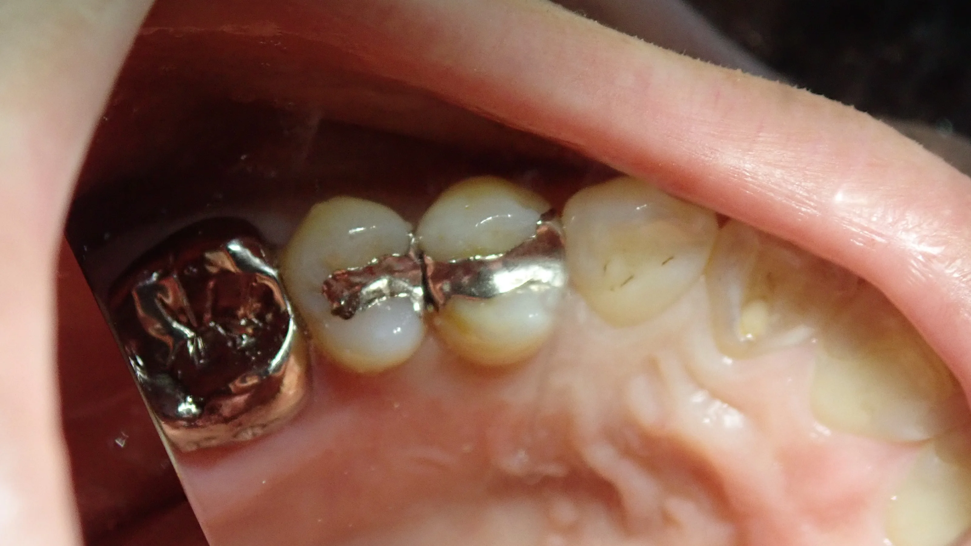 小さい奥歯(小臼歯)の白い詰め物｜坂寄歯科医院（取手市藤代） - 画像2