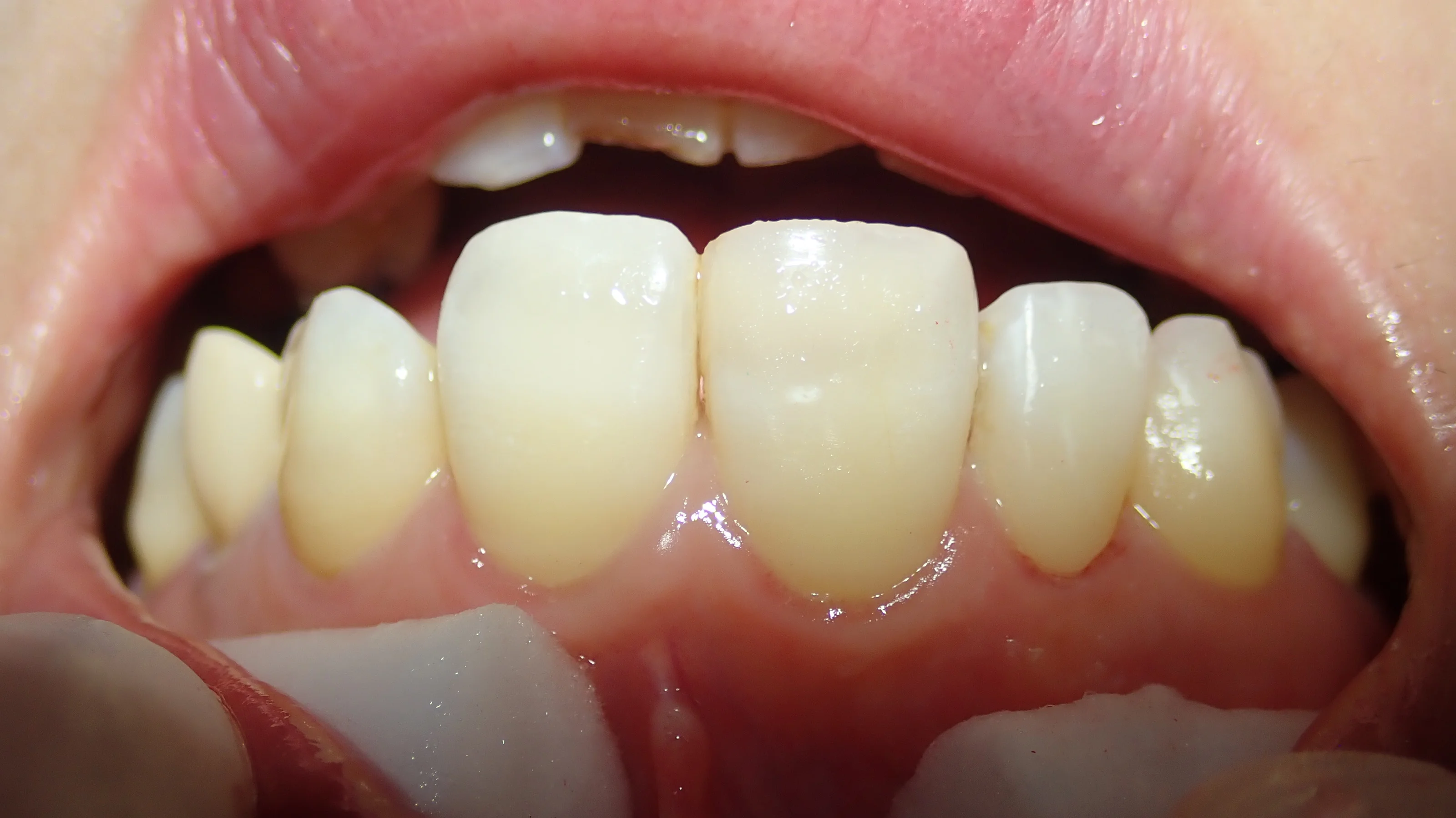 前歯ダイレクトボンディング②｜坂寄歯科医院（取手市藤代） - 画像2