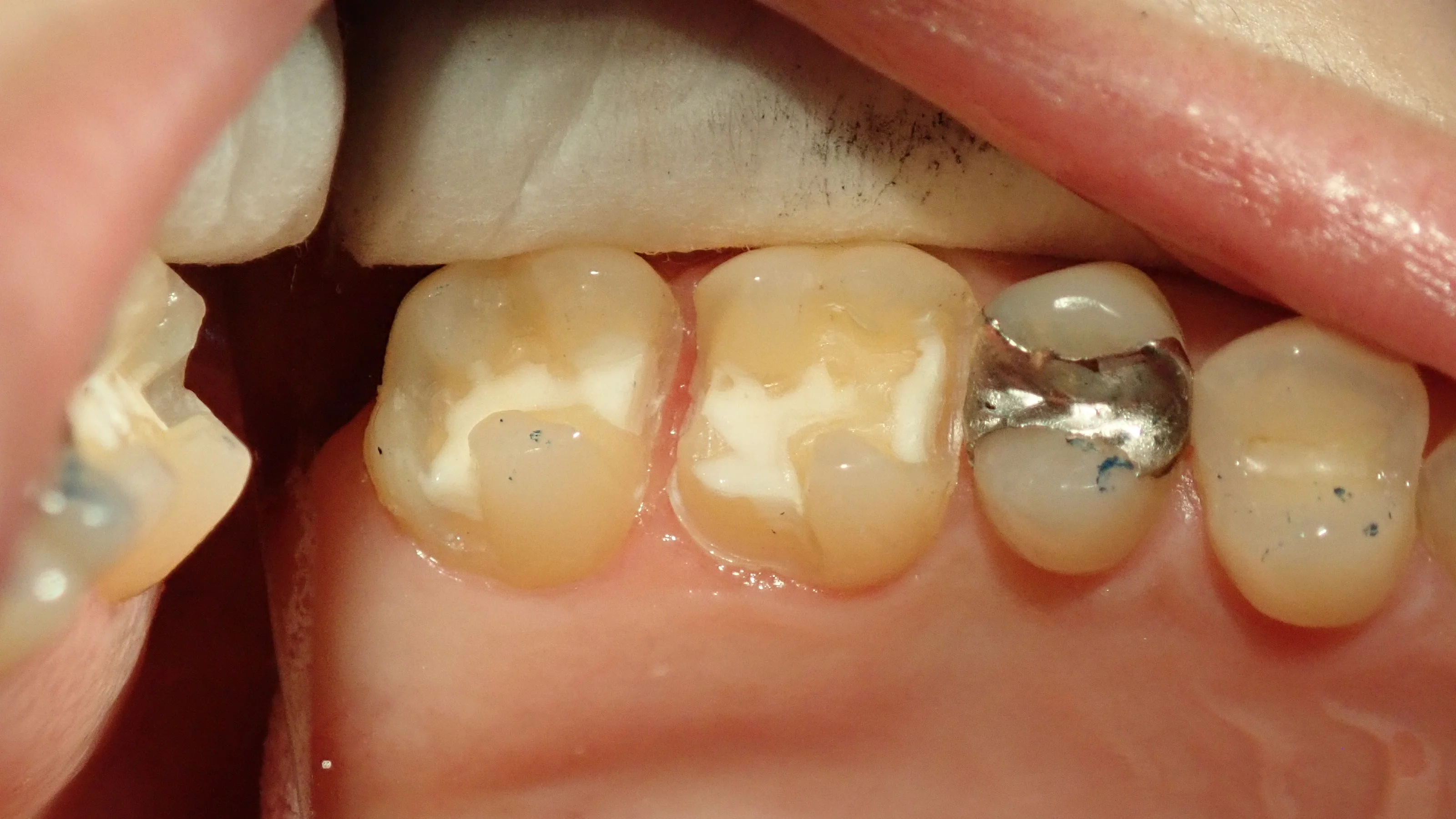 メタルインレー|坂寄歯科医院(取手市藤代) - 画像3