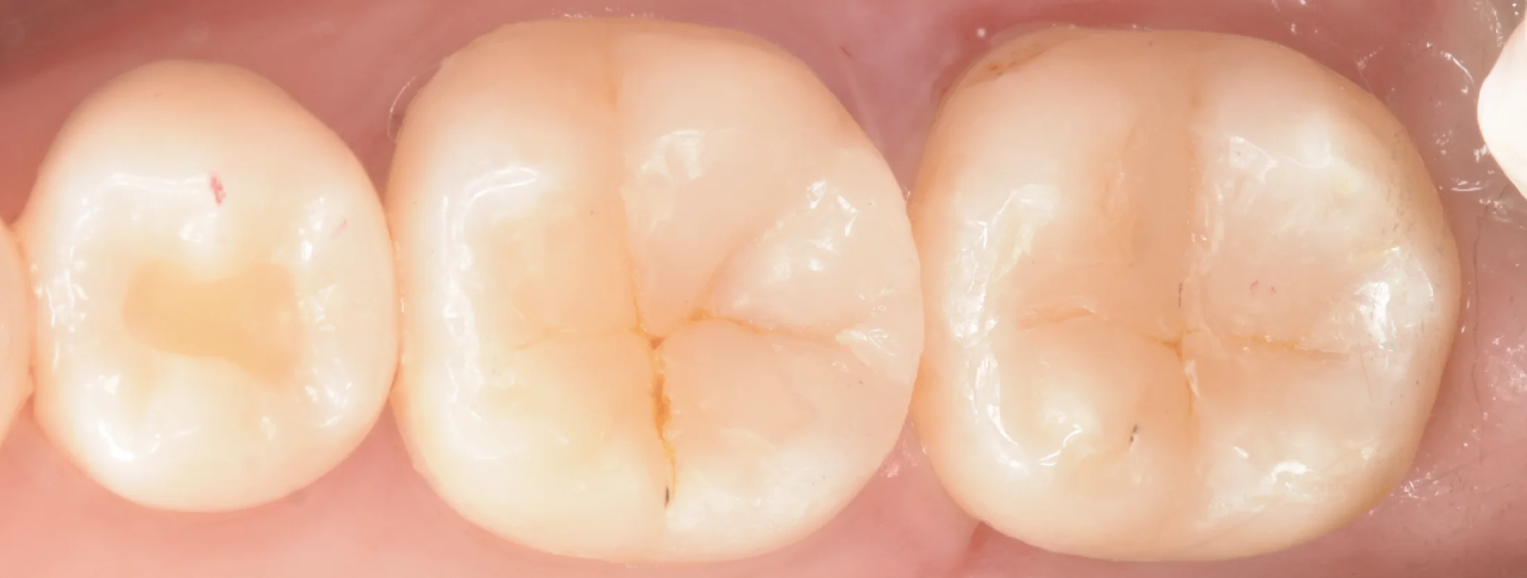 歯科医師の方のCAD/CAMインレーを治療。|坂寄歯科医院(取手市藤代) - 画像8