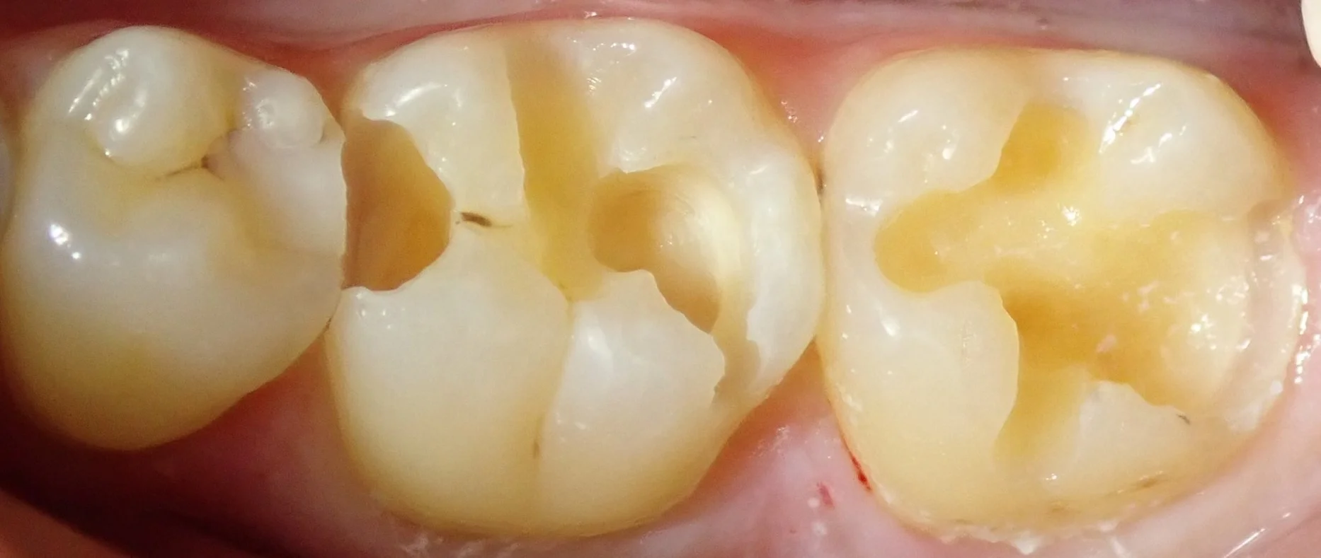 左下奥2本の白い詰め物｜坂寄歯科医院（取手市藤代） - 画像2