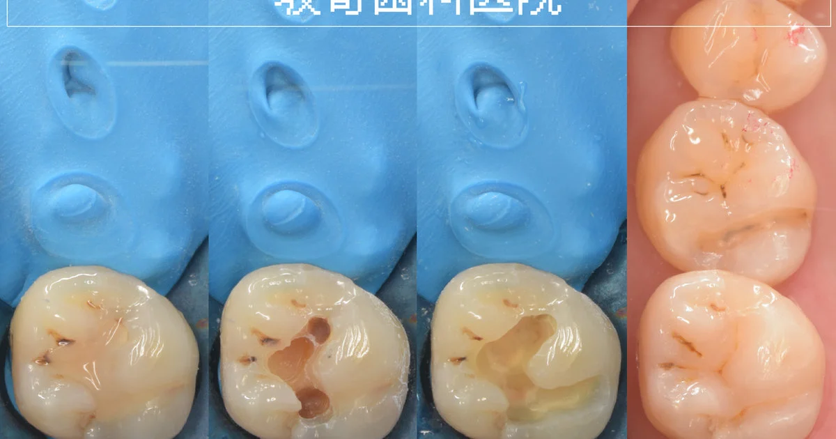 ダイレクトボンディング症例｜奥歯の再治療｜歯が欠けた（30代女性）