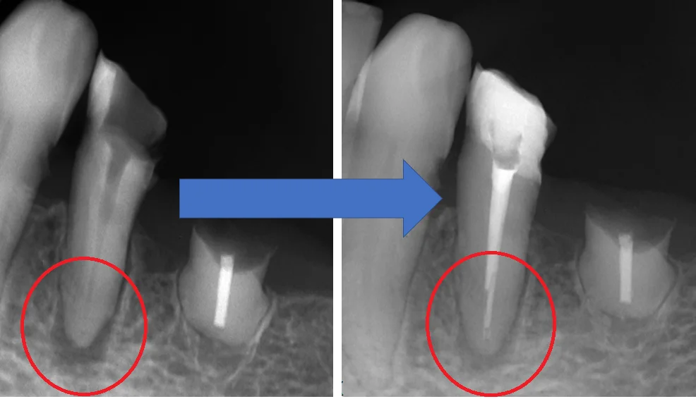 神経の治療④|坂寄歯科医院(取手市藤代) - 画像3