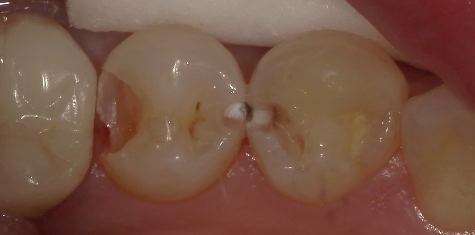 右下奥歯を纏めて治療。遠方からの通院。|坂寄歯科医院(取手市藤代) - 画像2