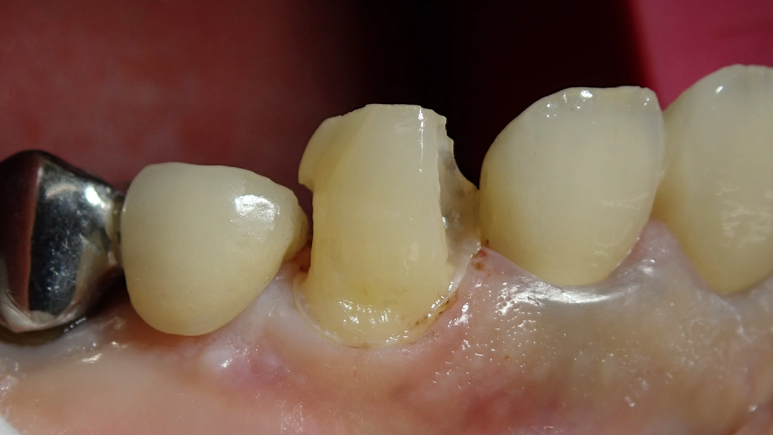 犬歯ダイレクトボンディング|坂寄歯科医院(取手市藤代) - 画像3