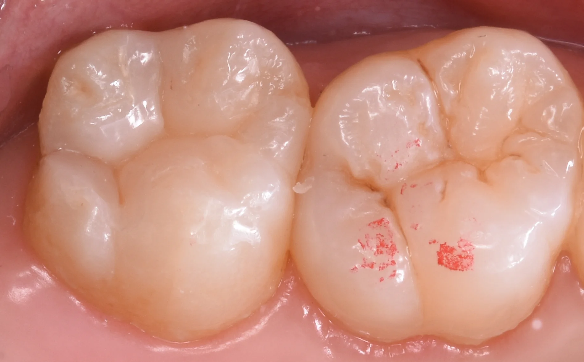 上の奥歯を金属から白い詰め物に。|坂寄歯科医院(取手市藤代) - 画像4