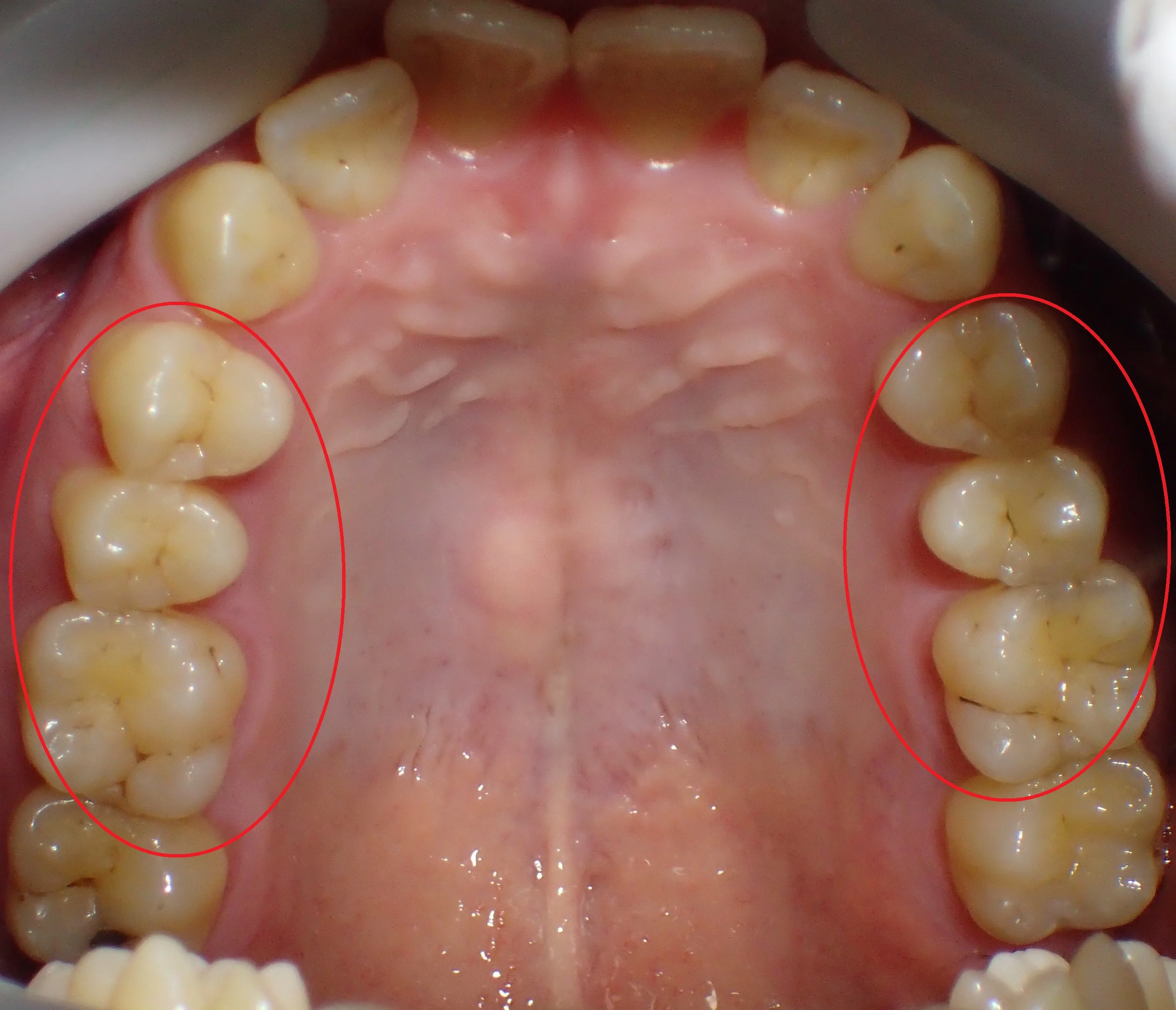 ダイレクトボンディングによる治療|坂寄歯科医院(取手市藤代) - 画像3