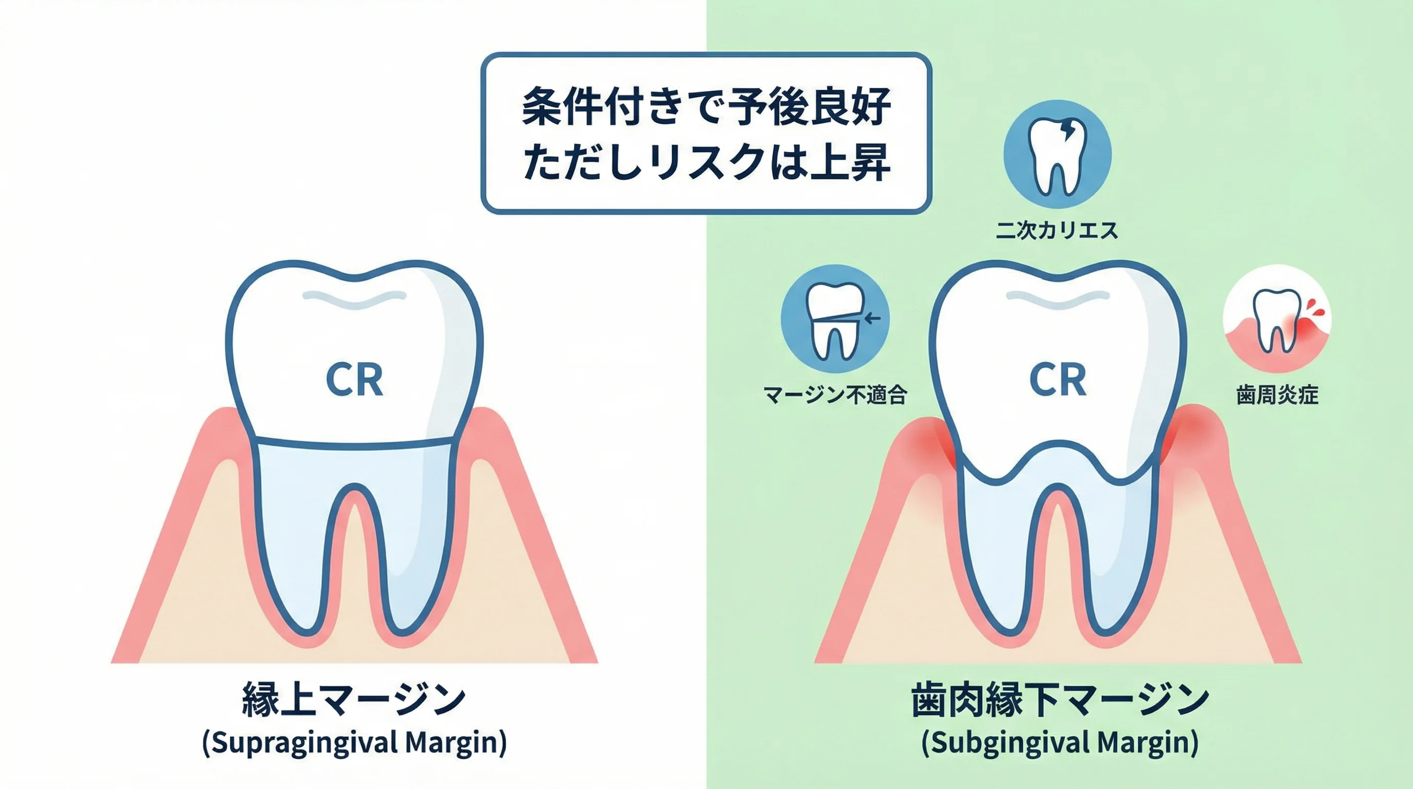 縁上マージンと歯肉縁下マージンにおけるコンポジットレジン修復を比較し、歯肉縁下で二次カリエスや歯周炎リスクが高まる可能性を説明する図