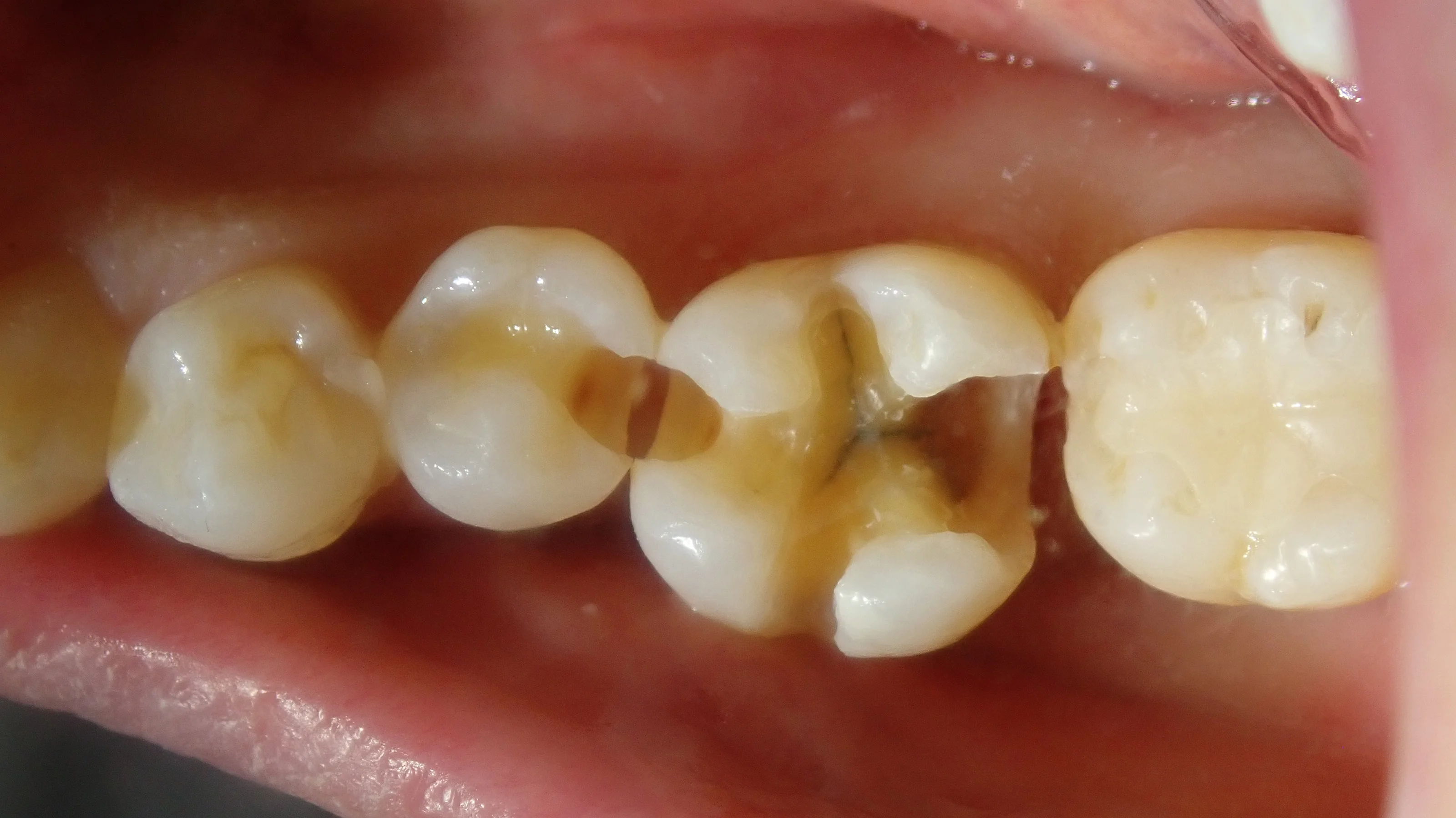 ダイレクトボンディング⑦｜坂寄歯科医院（取手市藤代） - 画像4