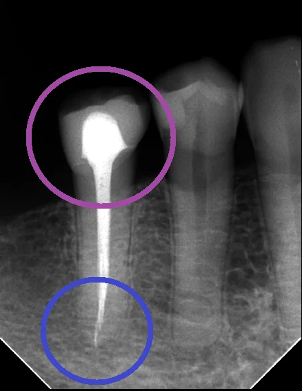 レジンでは無理ですって!|坂寄歯科医院(取手市藤代) - 画像3