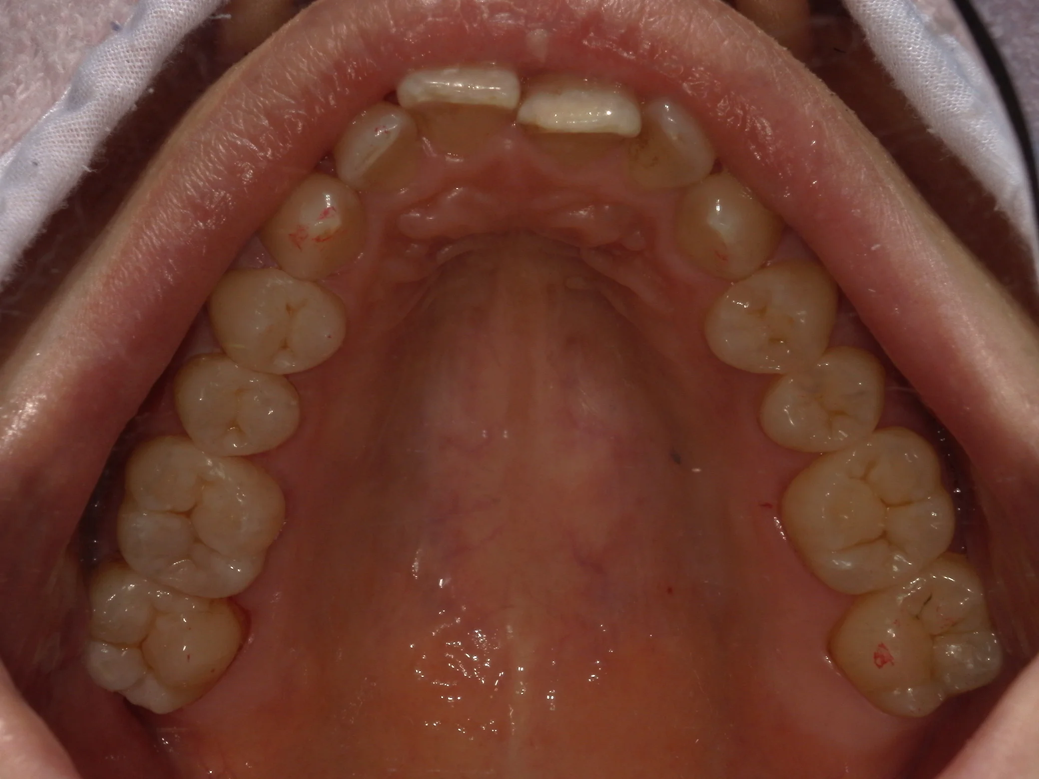 全体的に金属を白い詰め物に。|坂寄歯科医院(取手市藤代) - 画像6